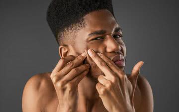 A acne é uma condição prevalente na adolescência capaz de afetar também o psicológico - iStock