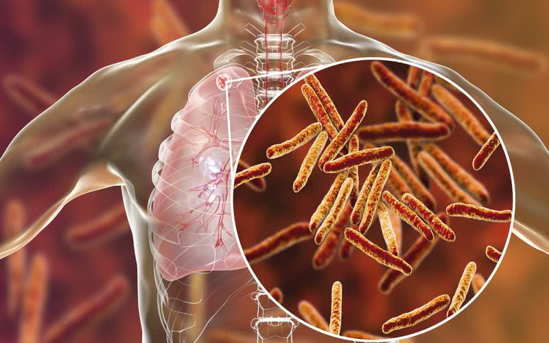 Se não for diagnosticada logo e tratada, a TB pode levar à morte - iStock