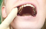 Além do amarelamento, cigarros podem causar cárie, periodontite e a perda de dentes, o que abala a autoestima - iStock