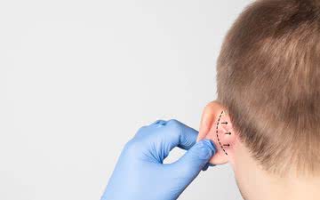 A correção da chamada orelha de abano é o procedimento mais procurado entre os mais jovens - iStock