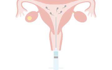 A inseminação intrauterina (foto) é um tratamento de baixa complexidade, ao contrário da fertilização in vitro - iStock