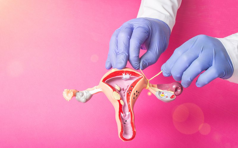 A laqueadura é um procedimento que interrompe a fertilidade da mulher de forma definitiva - iStock