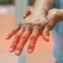 Formigamento ou dor nas mãos ou nos pés podem indicar danos aos nervos causados pelo diabetes - iStock