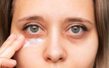 O tratamento das olheiras irá depender do tipo, por isso, é importante consultar um dermatologista - iStock
