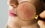 Segundo a Sociedade Brasileira de Dermatologia (SBD), a rosácea atinge de 1,5% a 10% da população - iStock