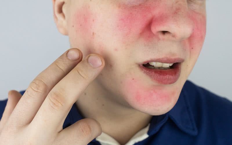 O rubor é uma dilatação dos vasos, com aumento de fluxo de sangue para a pele - iStock